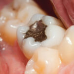 Learn About The Positive Effects Of Dental Fillings