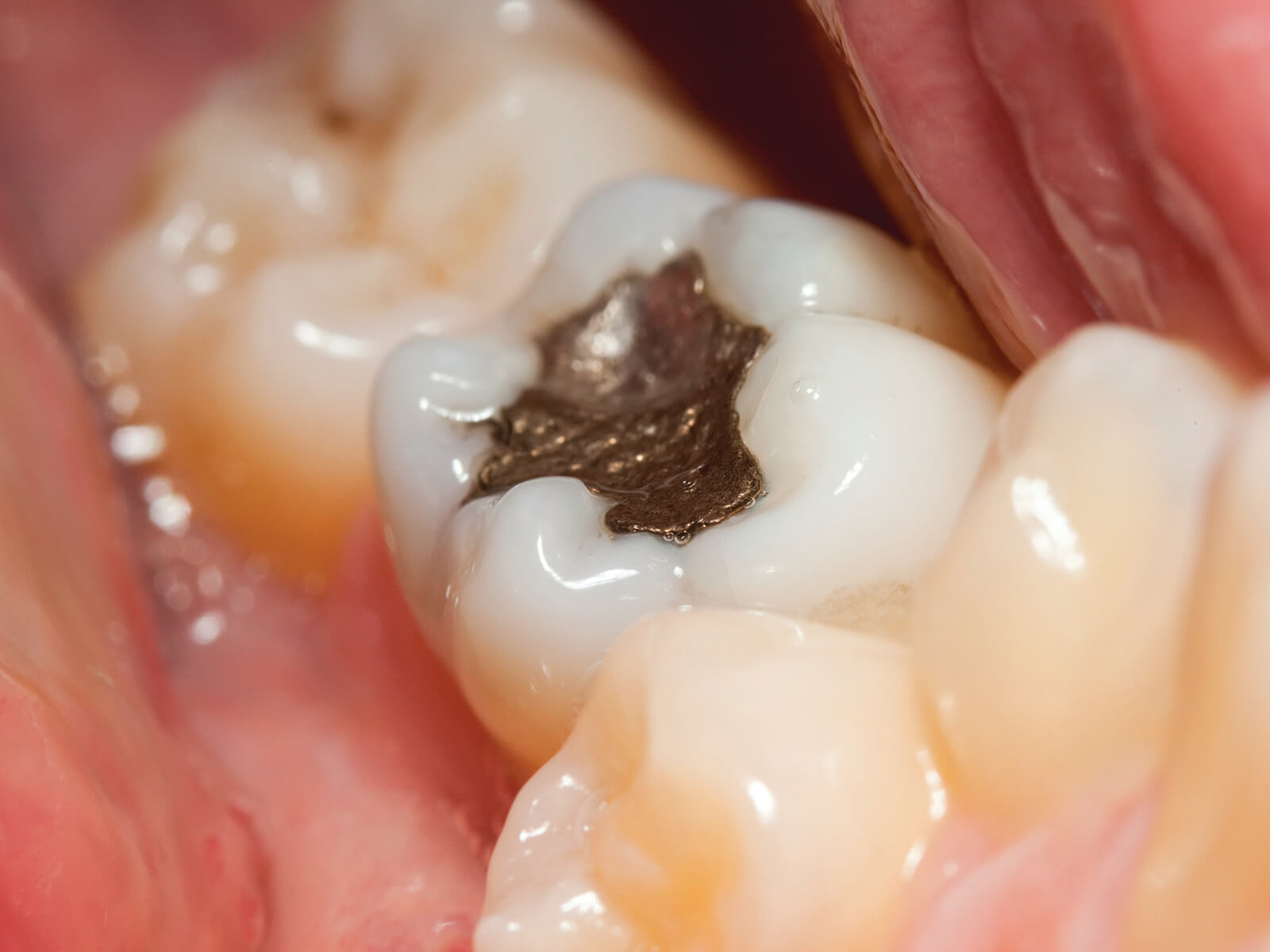 Learn About The Positive Effects Of Dental Fillings