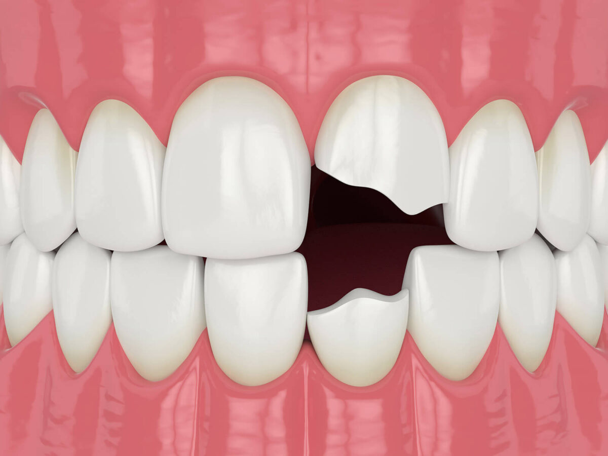 Chipped Teeth: When Is It An Emergency?