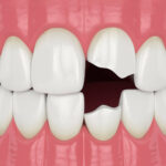 Chipped Teeth: When Is It An Emergency?