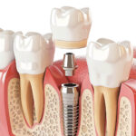 Determining Which Kind of Dental Implant Is Right for You