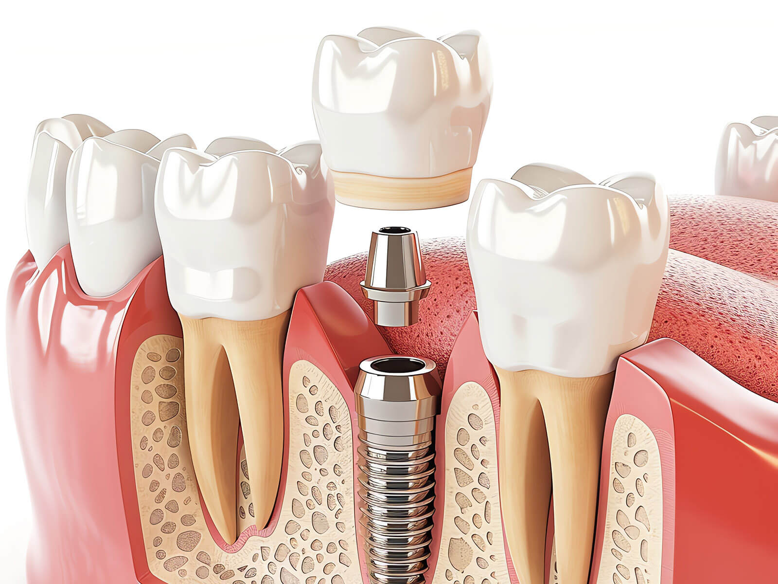 Determining Which Kind of Dental Implant Is Right for You