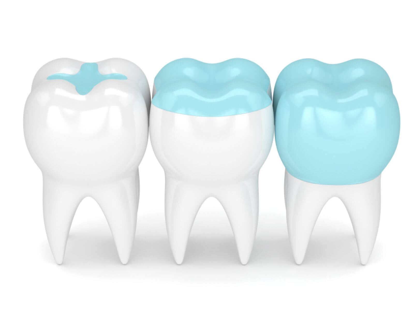 The Benefits of Dental Inlays And Onlays