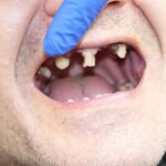 Top Causes of Dental Erosion And How To Prevent Them