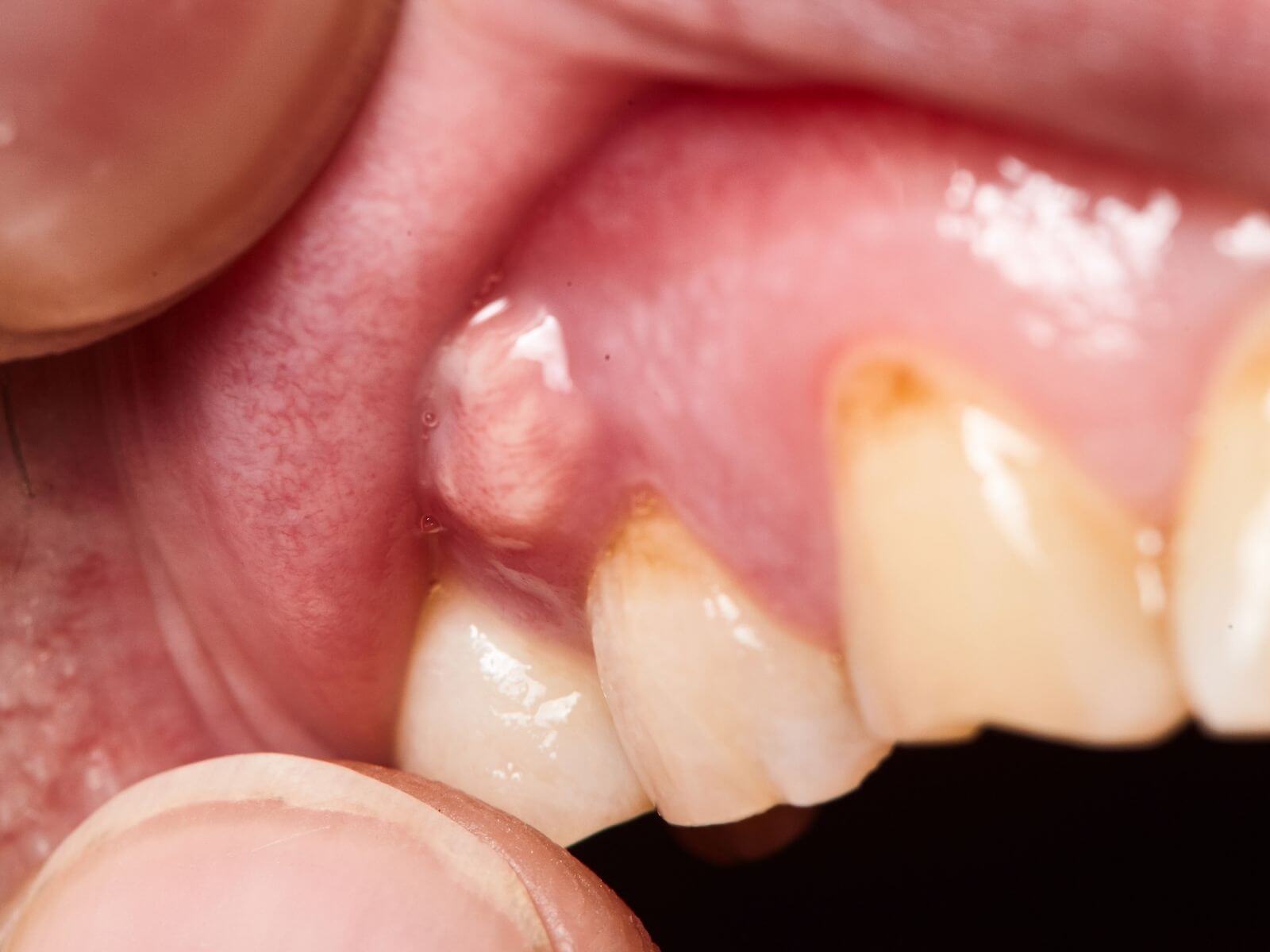 Understanding The Process of Incision And Drainage For Dental Abscess