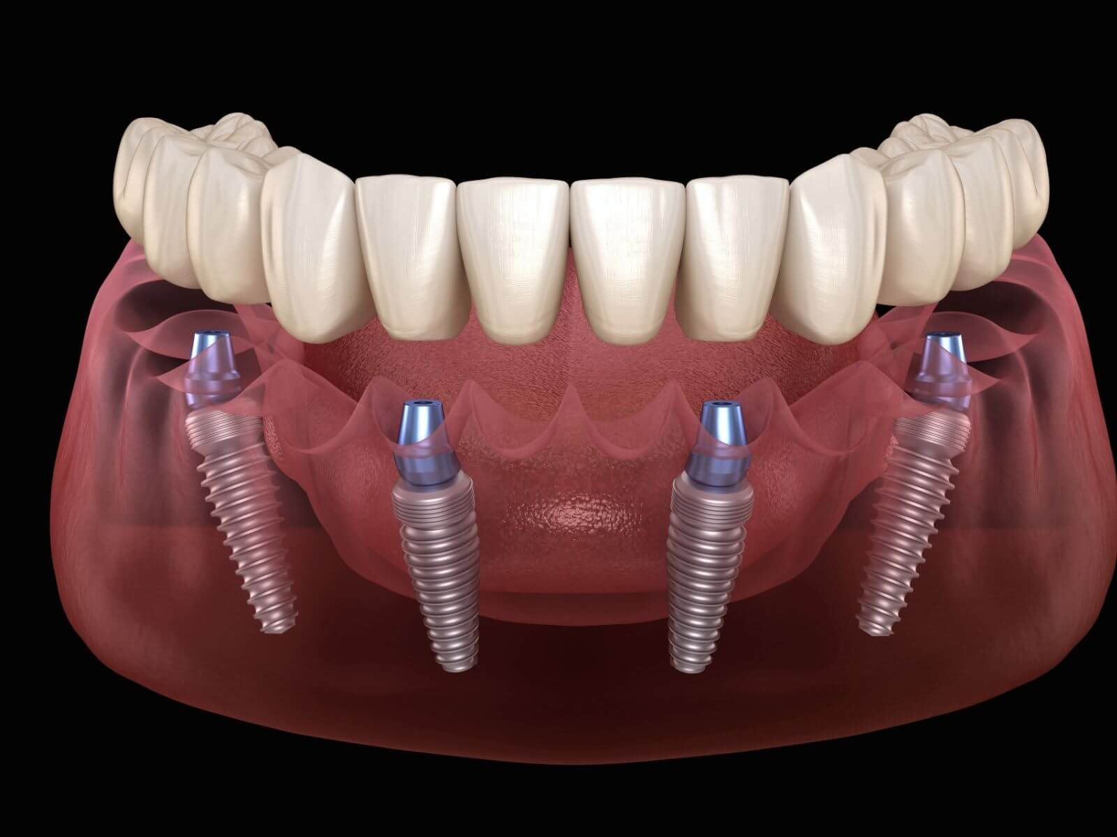 How Do I Clean My Dental Implants?